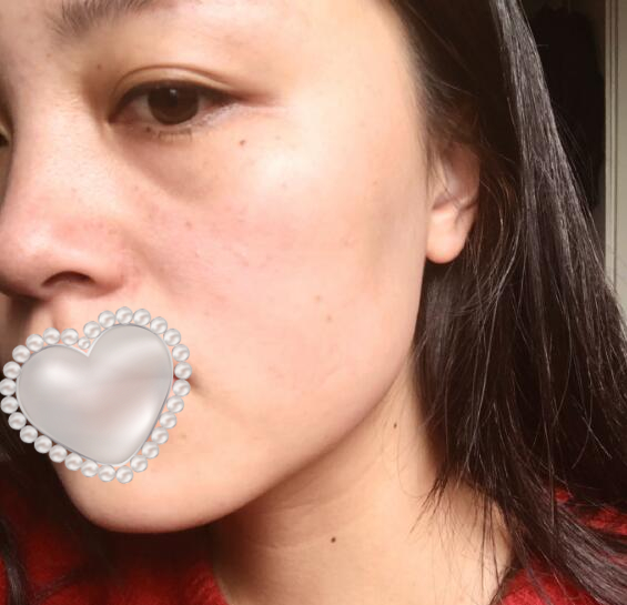 光子嫩膚果怎么樣