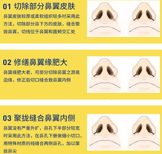 鼻翼肥大整形多少錢