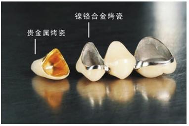 門牙烤瓷牙多少錢