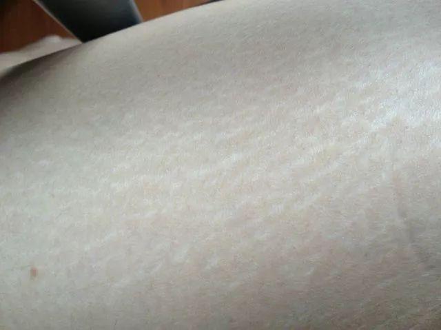 肥胖紋怎么消除