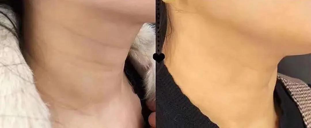 嗨體注射脖子除皺