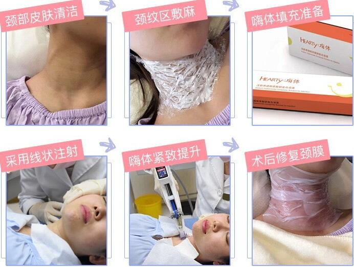 嗨體注射脖子除皺