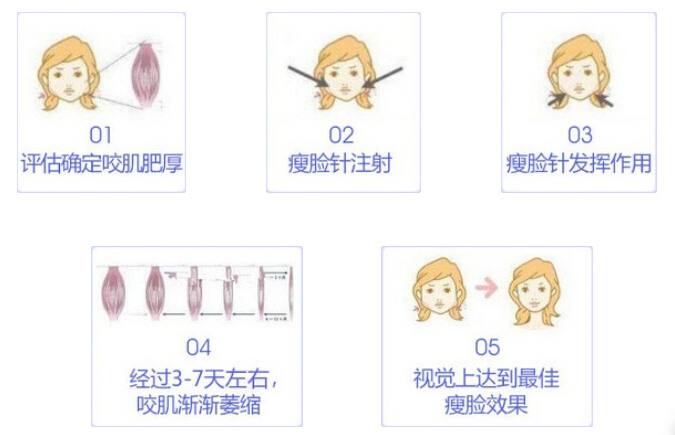 怎樣防止瘦臉注射瘦臉的不良反應(yīng)