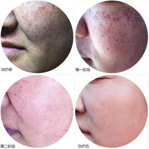 激光美膚激光祛雀斑好不好