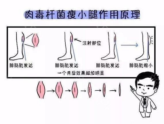 注射瘦臉注射瘦腿
