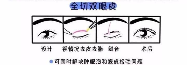 割一只雙眼皮多少錢