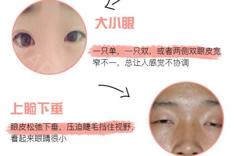 雙眼皮可以只割一只嗎