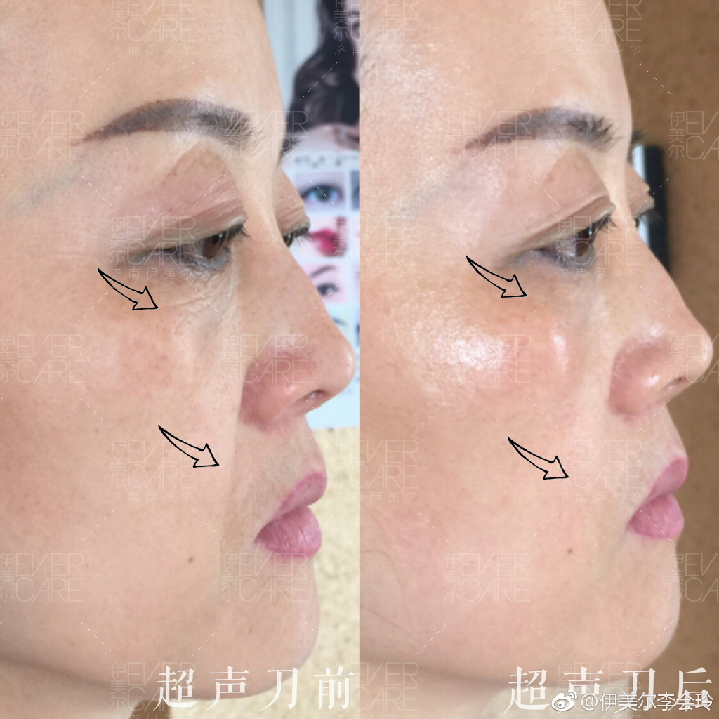 超聲提拉美容去除皺紋實際果怎么樣?