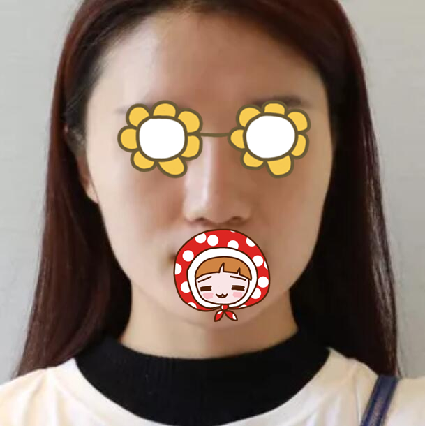 硅膠隆鼻果圖前后對比