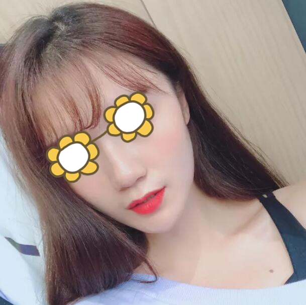 硅膠隆鼻果圖前后對比