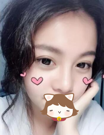 玻尿酸注射隆鼻果圖對比