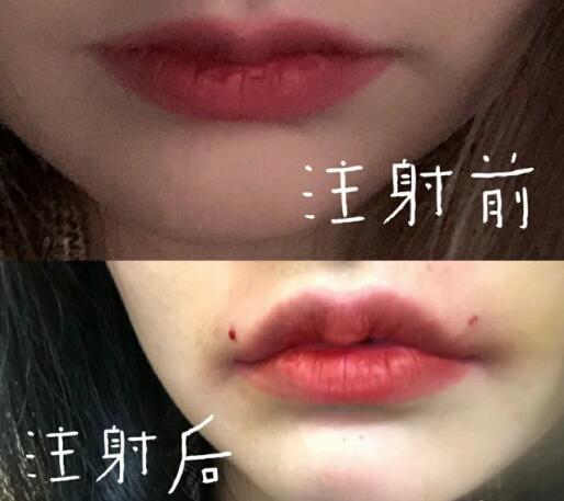 注射豐唇整形手術(shù)