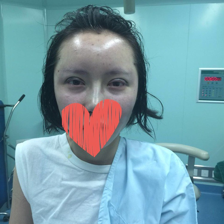 開外眼角果圖對比