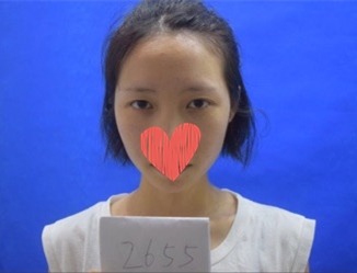 開外眼角果圖對比