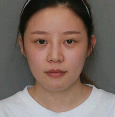 墊下巴前后對比圖