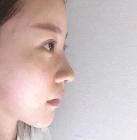 墊下巴前后對比圖