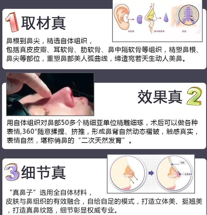 溫州美域高高志丹醫(yī)生科普隆鼻整形