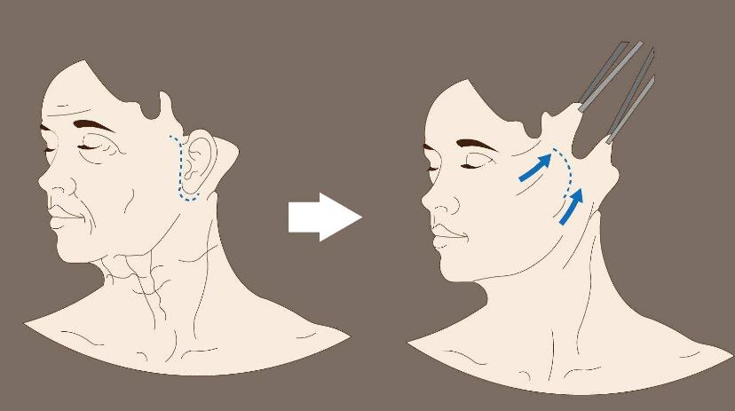 面部拉皮去皺整形
