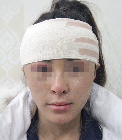 面部拉皮去皺整形手術(shù)果圖