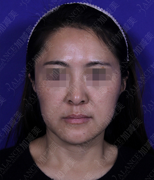 面部拉皮去皺整形手術(shù)果圖