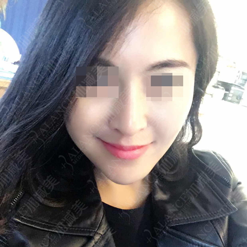 面部拉皮去皺整形手術(shù)果圖