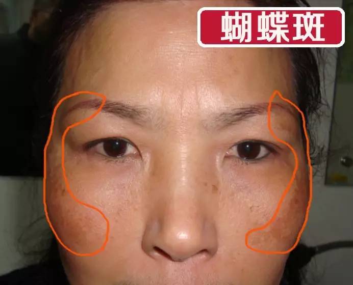 蝴蝶斑產(chǎn)生的原因
