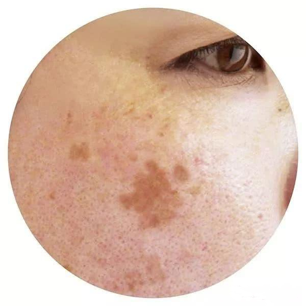 蝴蝶斑產(chǎn)生的原因