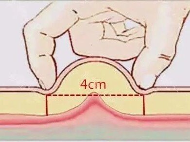 中醫(yī)埋線減肥方式