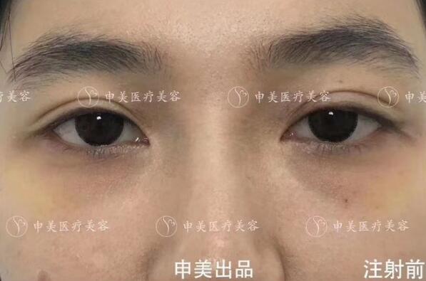 玻尿酸注射豐臥蠶