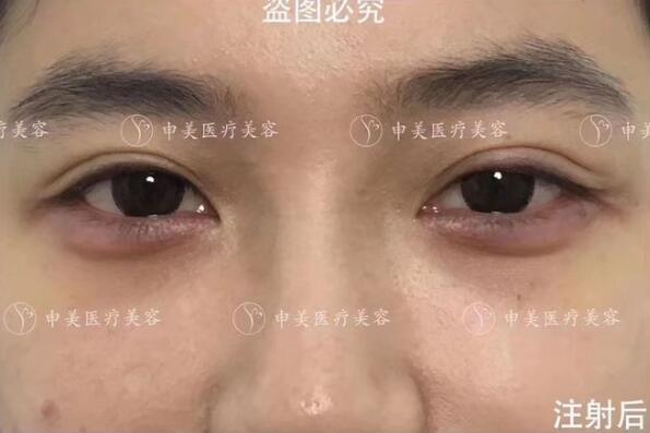 玻尿酸注射豐臥蠶