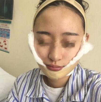 削骨瘦臉果圖分享