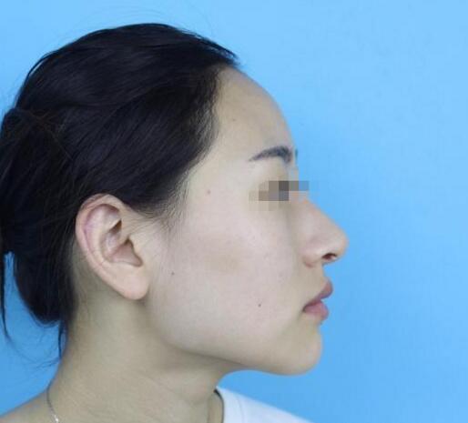 削骨瘦臉果圖分享