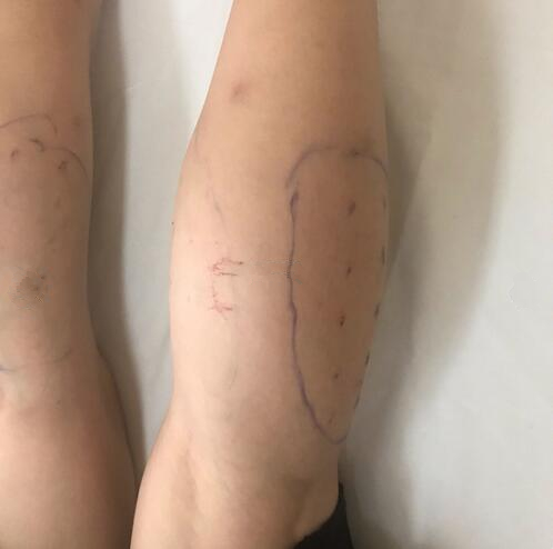 注射瘦臉注射瘦腿術(shù)后果圖分享