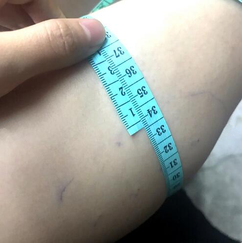 注射瘦臉注射瘦腿術(shù)后果圖分享