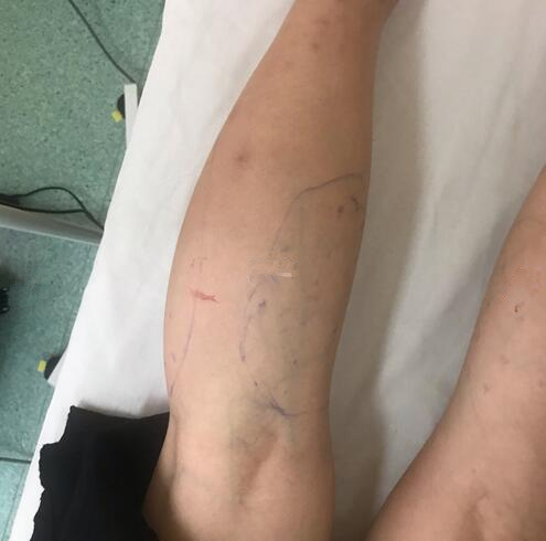 注射瘦臉注射瘦腿術(shù)后果圖分享