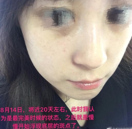 祛黃褐斑果圖分享