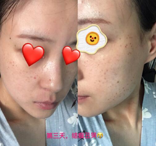 祛黃褐斑果圖分享