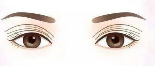 雙眼皮