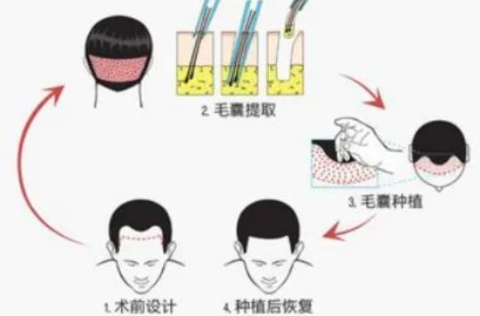 tddp植發(fā)技術(shù)