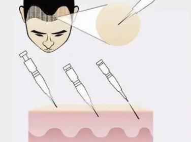 tddp植發(fā)技術(shù)