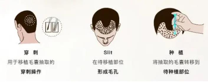 tddp植發(fā)技術(shù)