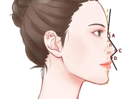 韓式自體軟骨隆鼻前后對比圖怎么樣？塌鼻梁秒變立體鼻，自然到媽生