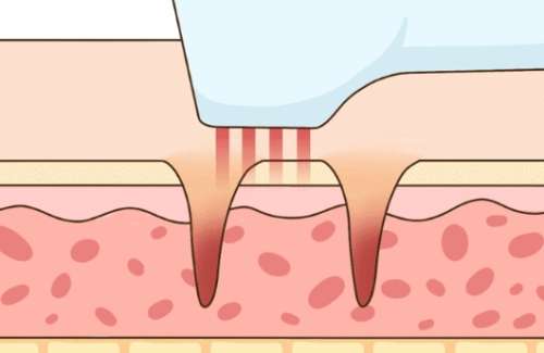 祛斑后反黑期真實(shí)照片怎么樣？過(guò)來(lái)人看看恢復(fù)情況如何