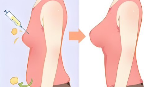 自體脂肪隆胸后有結(jié)節(jié)怎么辦？結(jié)節(jié)類(lèi)型鑒別+處理方案對(duì)比，對(duì)號(hào)入座