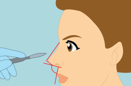 綜合鼻部整形看得出不？這幾個(gè)細(xì)節(jié)最容易暴露