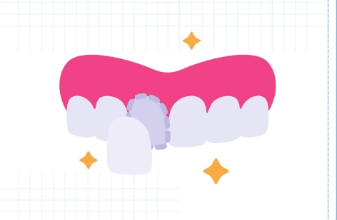 杭州雅萊牙齒貼面多少錢(qián)？費(fèi)用區(qū)間+注意事項(xiàng)整理
