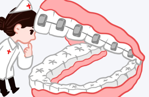 廣東總隊醫(yī)院矯正牙齒價格，牙套類型+價格區(qū)間參考