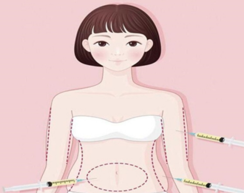 胳膊環(huán)吸多少錢？價格大概在這個范圍