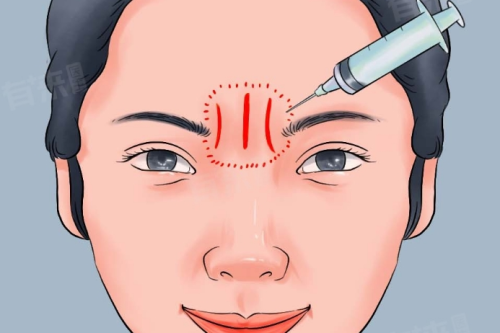 去川字紋有什么副作用？醫(yī)生不主動說的注意事項在這里